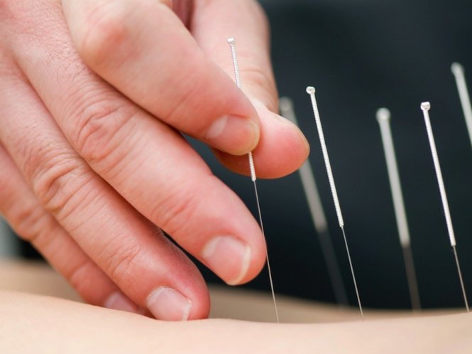 6 Cách trị chàm da theo phương pháp tự nhiên, dễ làm, ít tác dụng phụ 3 - 3 Châm cứu có thể giúp giảm ngứa ở những người bị bệnh chàm.
