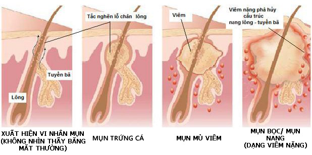Mụn tuổi dậy thì có tự hết không? 1 - 1 Giải quyết nỗi lo mụn tuổi dậy thì – www.sebamed.com.vn