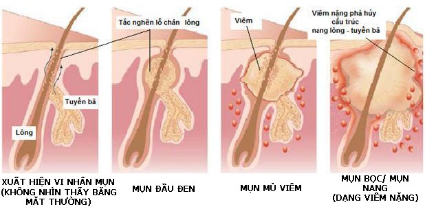 Nguyên Nhân Gây Mụn Và Cách Chăm Sóc Da Mụn 4 - 4 Nguyên nhân gây mụn và cách chăm sóc da mụn – www.sebamed.com.vn