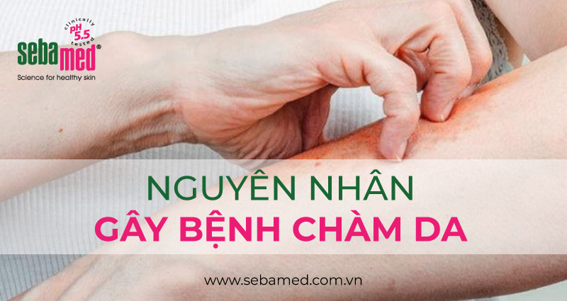 Nguyên nhân gây bệnh chàm da (eczema).