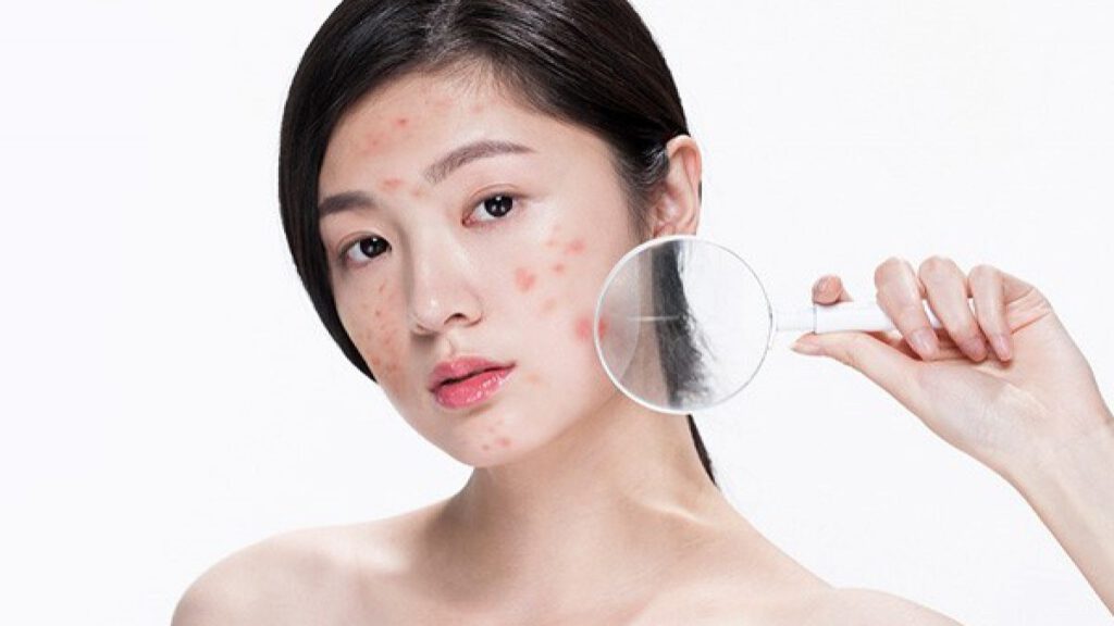 Ăn thực phẩm nhiều dầu mỡ có thể gây mụn – www.sebamed.com.vn