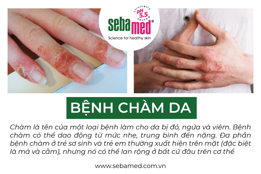 Bệnh Chàm là gì? 1 - 1 Bệnh chàm là gì?