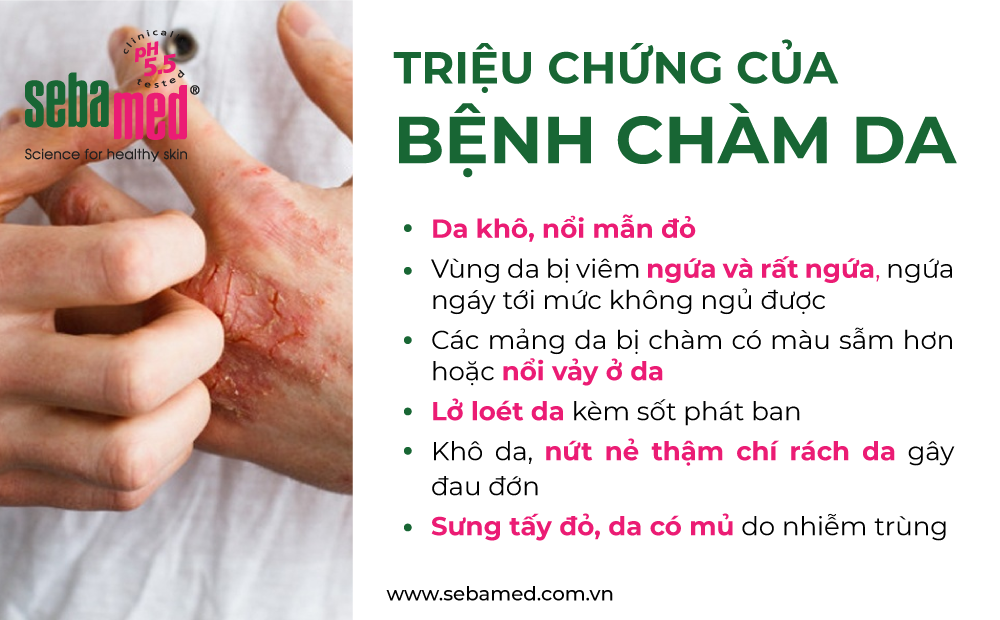 Bệnh Chàm là gì? 2 - 2 Bệnh chàm