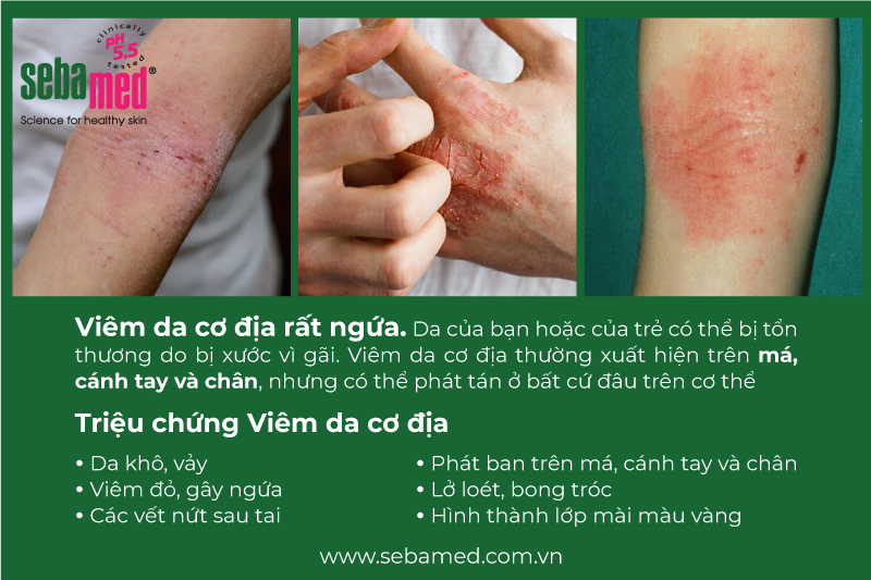 Viêm Da Cơ Địa Và Những Điều Cần Biết 2 - 2 Viêm da cơ địa
