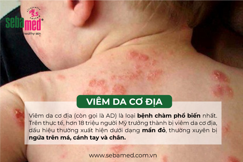 Viêm Da Cơ Địa Và Những Điều Cần Biết 1 - 1 viêm da cơ địa