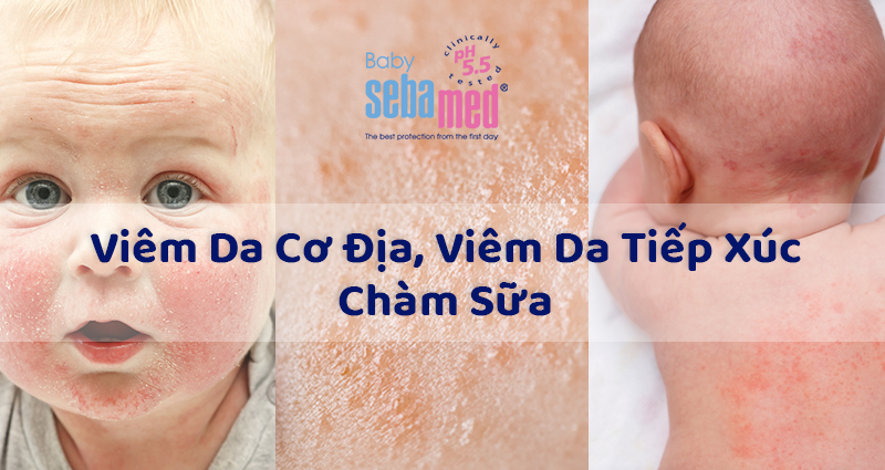 Dấu hiệu bị chàm sữa ở trẻ sơ sinh tiêu biểu.