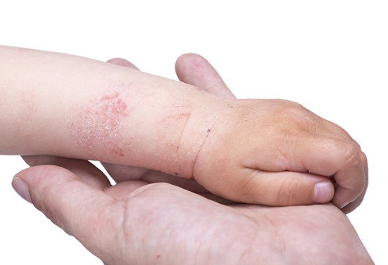 benh cham eczema 1 - 3 - Sebamed