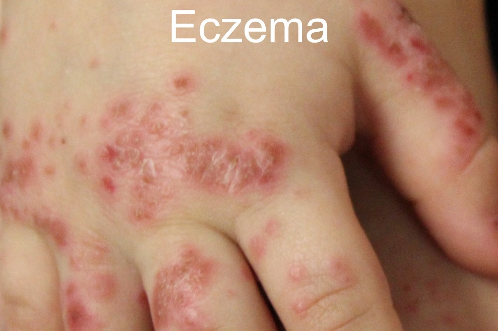 eczema tre duoi 2 tuoi - 5 - Sebamed