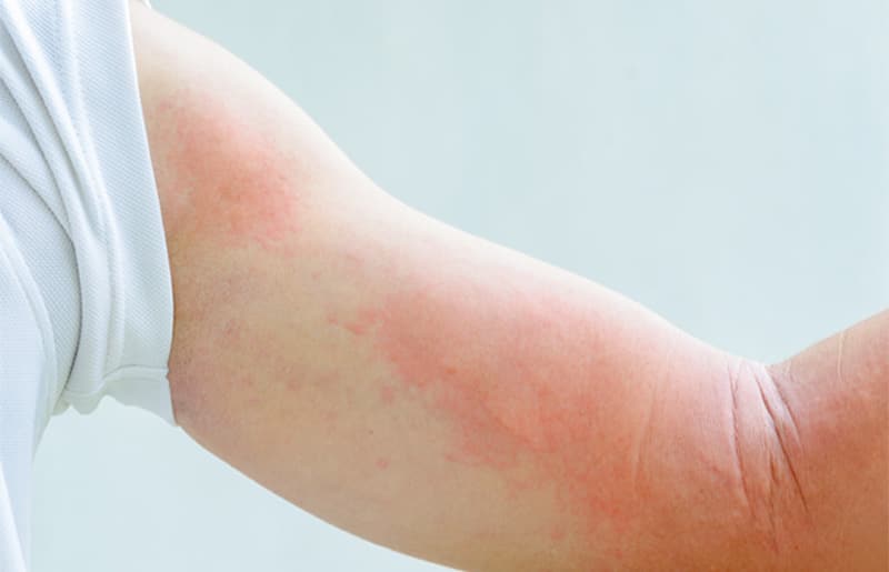 eczema tuoi day thi - 7 - Sebamed