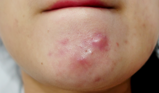 5 Loại mụn trứng cá thường gặp nhất có thể bạn chưa biết 6 - 6 Điểm Qua Các Loại Mụn Trứng Cá – www.sebamed.com.vn