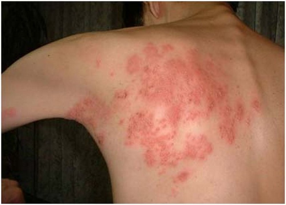 Đánh giá Gel dưỡng ẩm Sebamed: Vị cứu tinh khi không còn loại dưỡng ẩm nào hiệu quả. 6 - 12 tinh trang vay nen xuat hien tren da - 11 - Sebamed