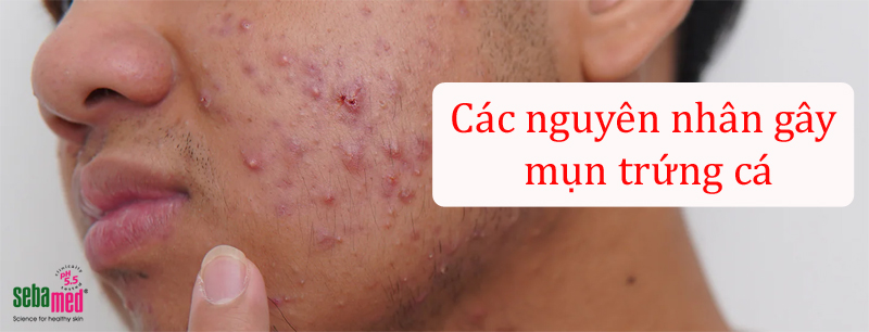 Những nguyên nhân gây mụn trứng cá xuất hiện phổ biến 3 - 3 Mụn trứng cá là gì? Tìm hiểu các nguyên nhân mọc mụn trứng cá.