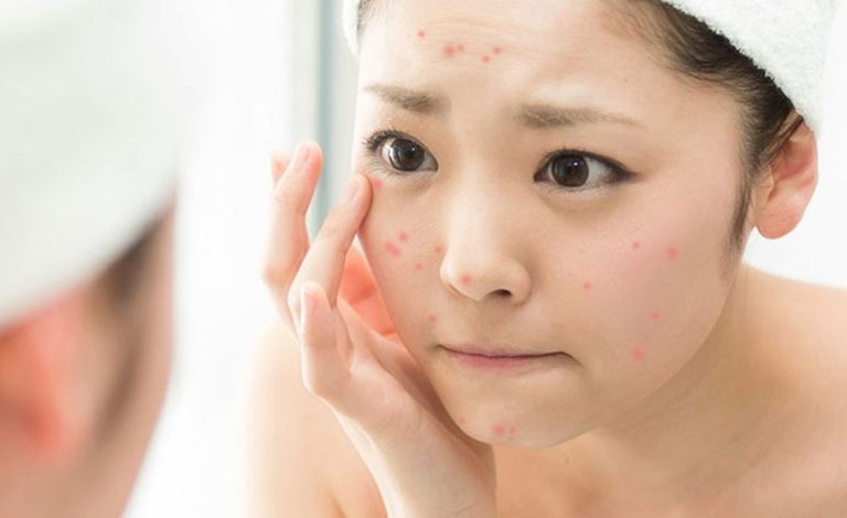 Panthenol là gì? Có những công dụng gì? 4 - 4 Cách-trị-mụn-tại-nhà-nhanh-nhất