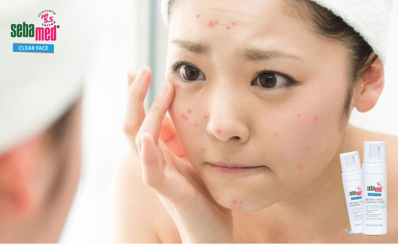Cách trị mụn tại nhà hiệu quả nhanh nhất sau 1 đêm 1 - 1 Cách trị mụn hiệu quả nhanh nhất sau 1 đêm – www.sebamed.com.vn
