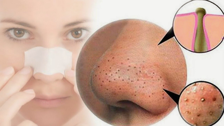8 Cách trị mụn đầu đen nhanh chóng dễ làm tại nhà 1 - 1 Cách trị mụn đầu đen tại nhà – www.sebamed.com.vn