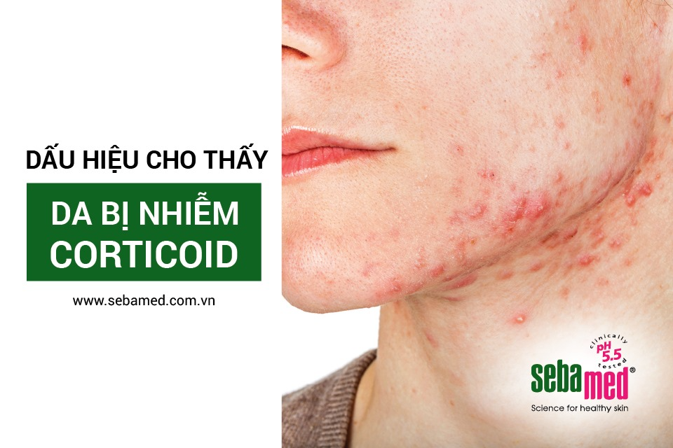 Dấu hiệu da nhiễm Corticoid dễ nhận biết nhất.