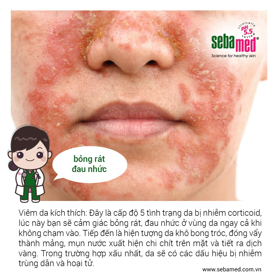Da nhiễm Corticoid nặng sẽ dẫn đến tình trạng viêm da kích thích.