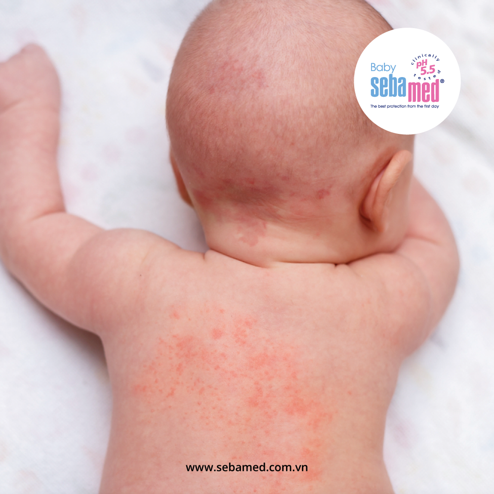 Các bệnh về da ở trẻ sơ sinh thường gặp 2 - 4 312 - 3 - Sebamed