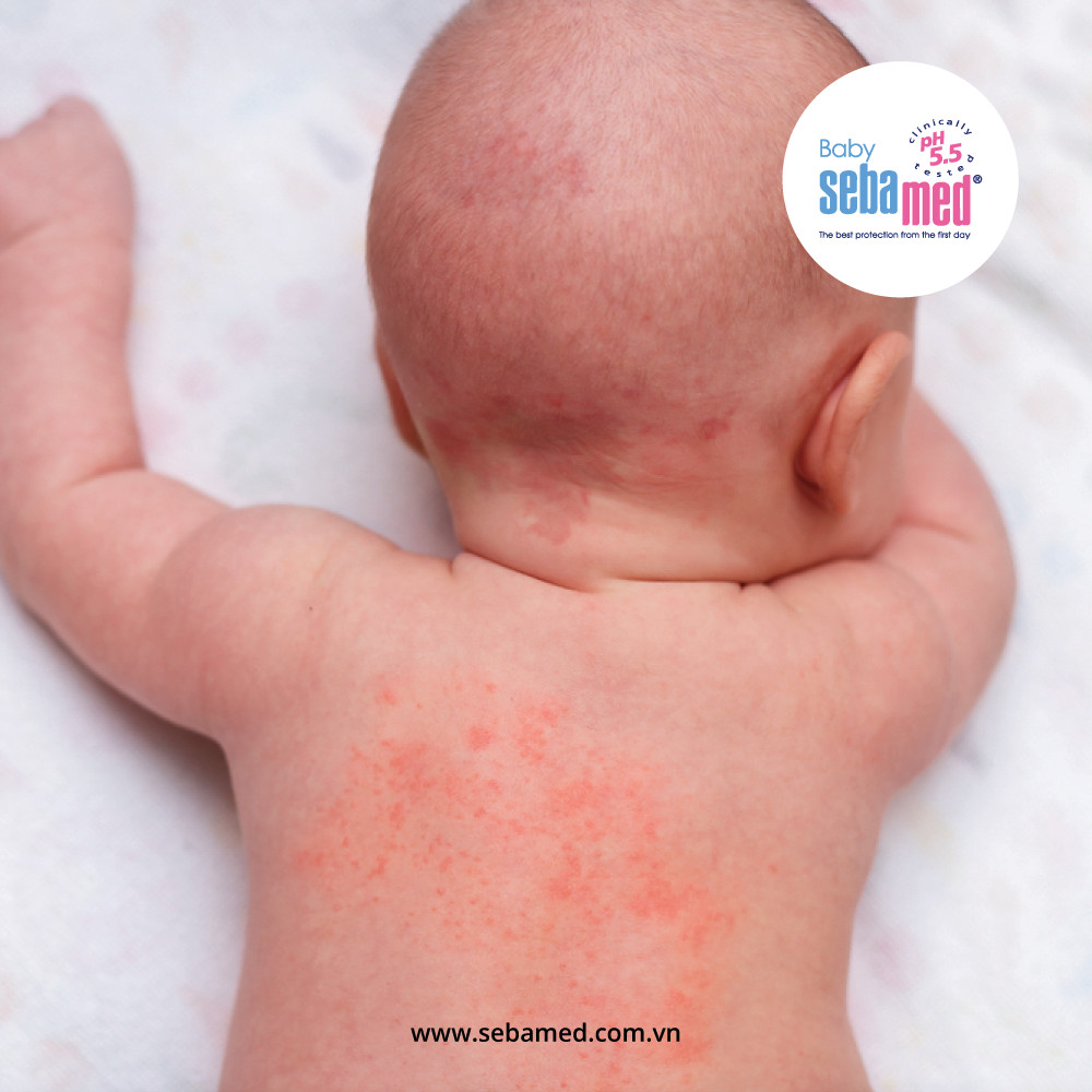 z2909859735622 a91255760963f61437a71bc17fada46e - 7 - Sebamed