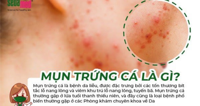 Những nguyên nhân gây mụn trứng cá xuất hiện phổ biến