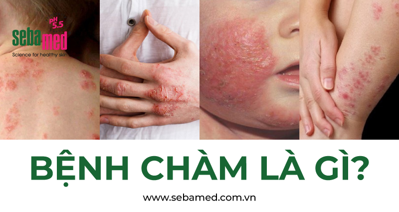 benh cham la gi - 3 - Sebamed
