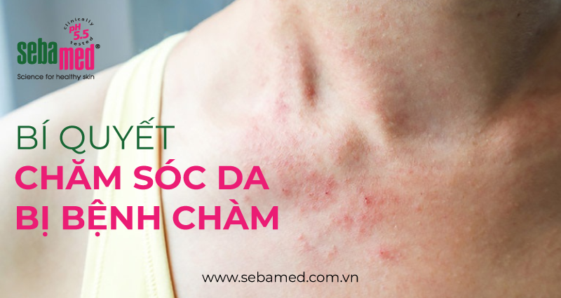 bi quyet cham soc da bi benh cham - 3 - Sebamed