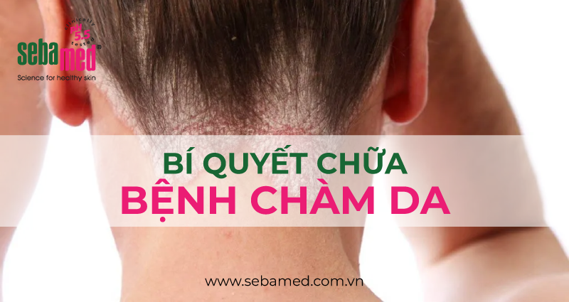 bi quyet chua benh cham da - 13 - Sebamed