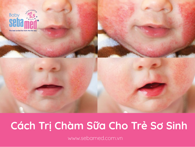 cach tri cham sua cho tre so sinh 1 - 24 - Sebamed