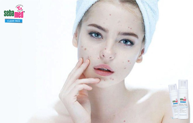 Top 5 Cách trị mụn thâm nhanh chóng, da sáng khỏe tươi tắn