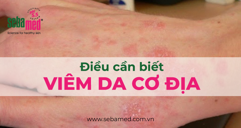 viem da co dia va nhung dieu can biet sebamed - 31 - Sebamed